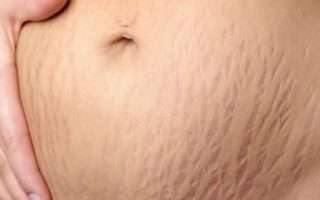 Stretch Mark