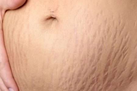 Stretch Mark