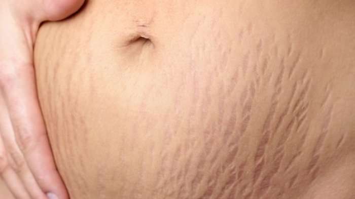 Stretch Mark